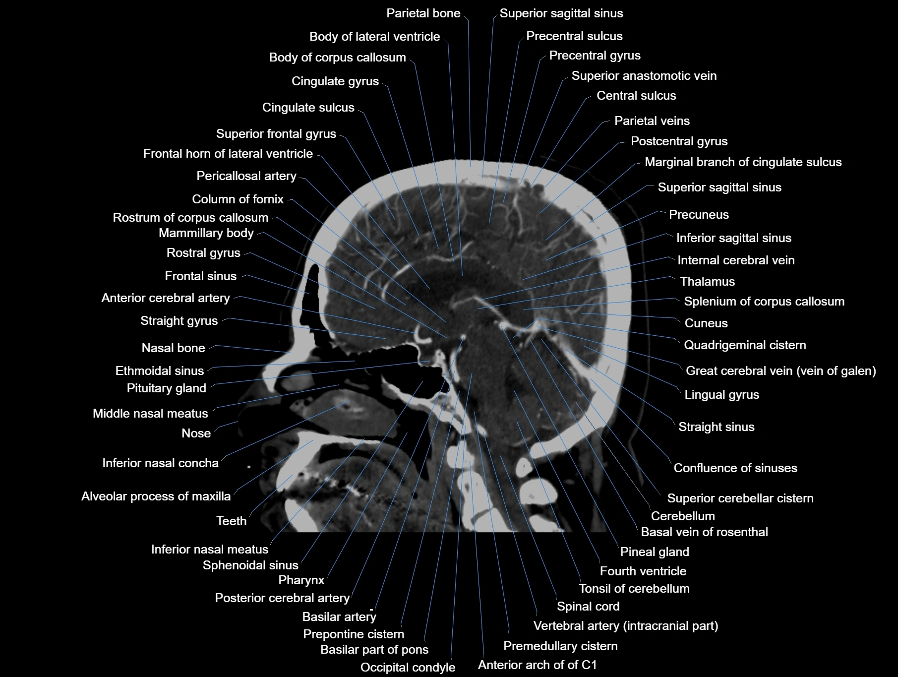 CT scan brain sagittal cross sectional anatomy image-img-00001-00038.webp